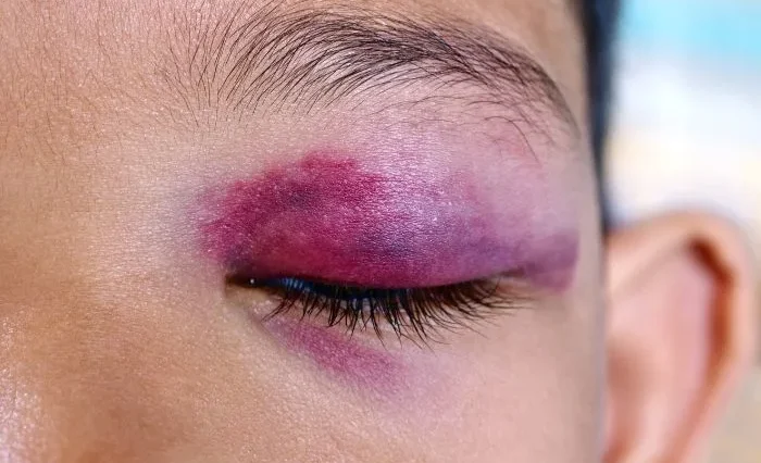 Ανεκδοτάρα με Τοτό: Ο Τοτός πάει μία μέρα στο σχολείο, με ένα μάτι πρησμένο και μελανιασμένο…